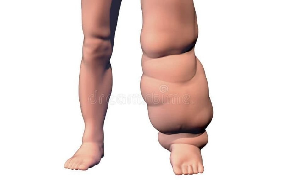 NTDs
